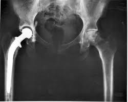 What Did the Prospective Study on the Pinnacle Hip Implant Reveal?